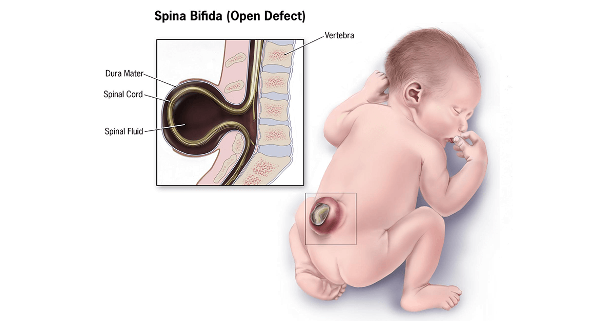 Spina Bifida Rehabilitasyonu